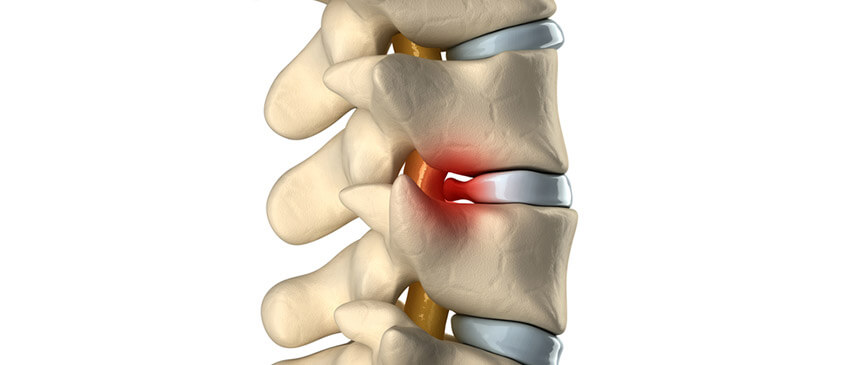 7 Tips for Relieving Pain From Herniated Discs
