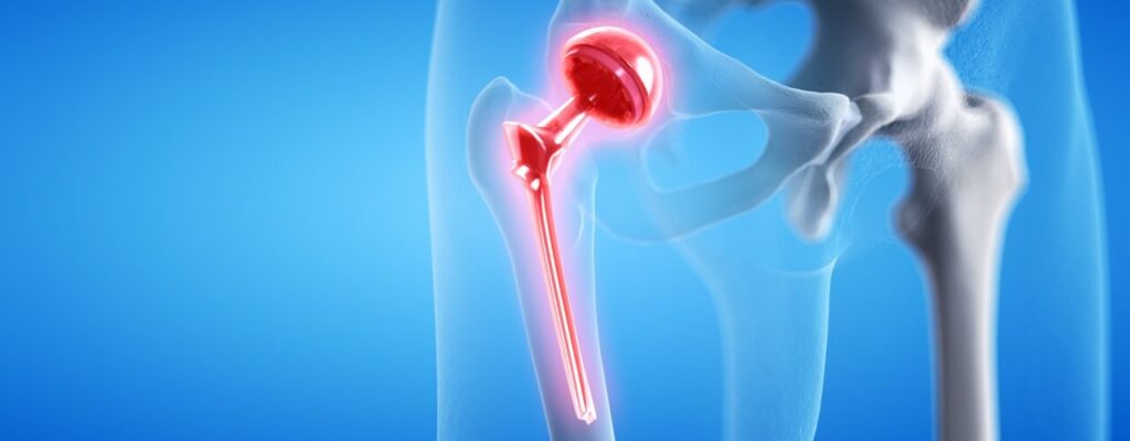 Maintaining Long-Term Hip Health: Hip Replacement Rehab Tips
