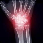 How to Manage Joint Inflammation from Arthritis