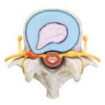 herniated disc