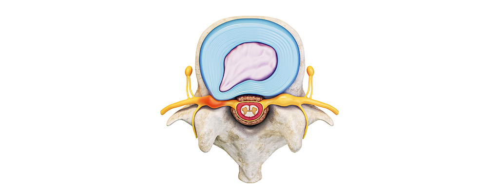 herniated disc
